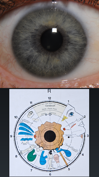 Eye Diagnosis