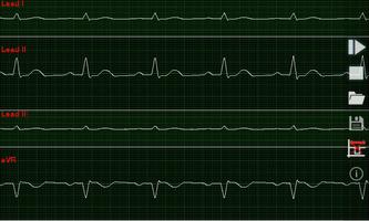 ABI-ECG