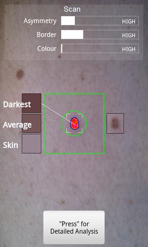 Doctor Mole - Skin cancer app