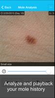 Skin Cancer App - MySkinPal