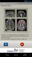MS diagnosis