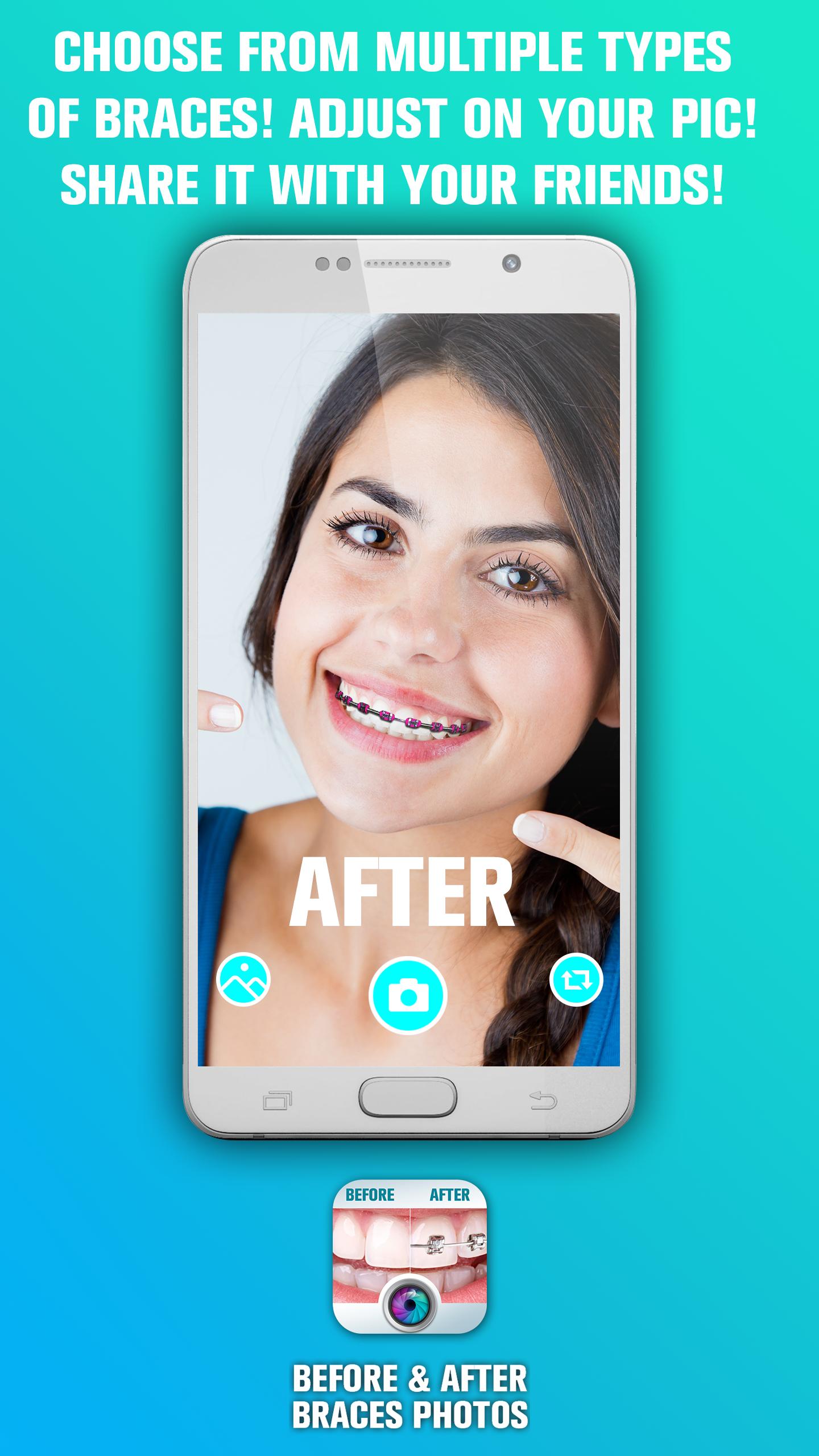 Dental Braces Before And After