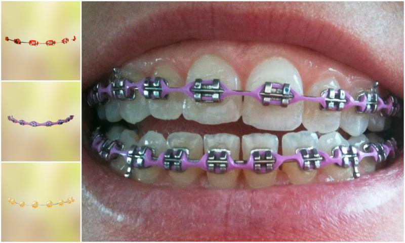 Real Teeth Braces Photo Maker