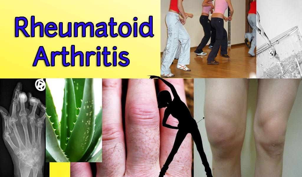 Rheumatoid Arthritis