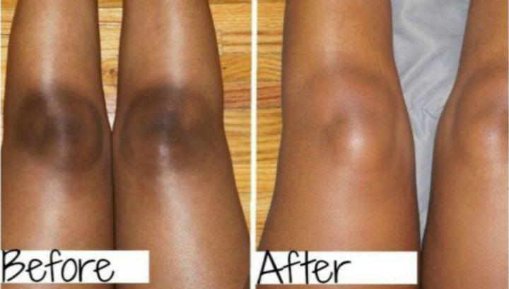 Bleaching the knees guide